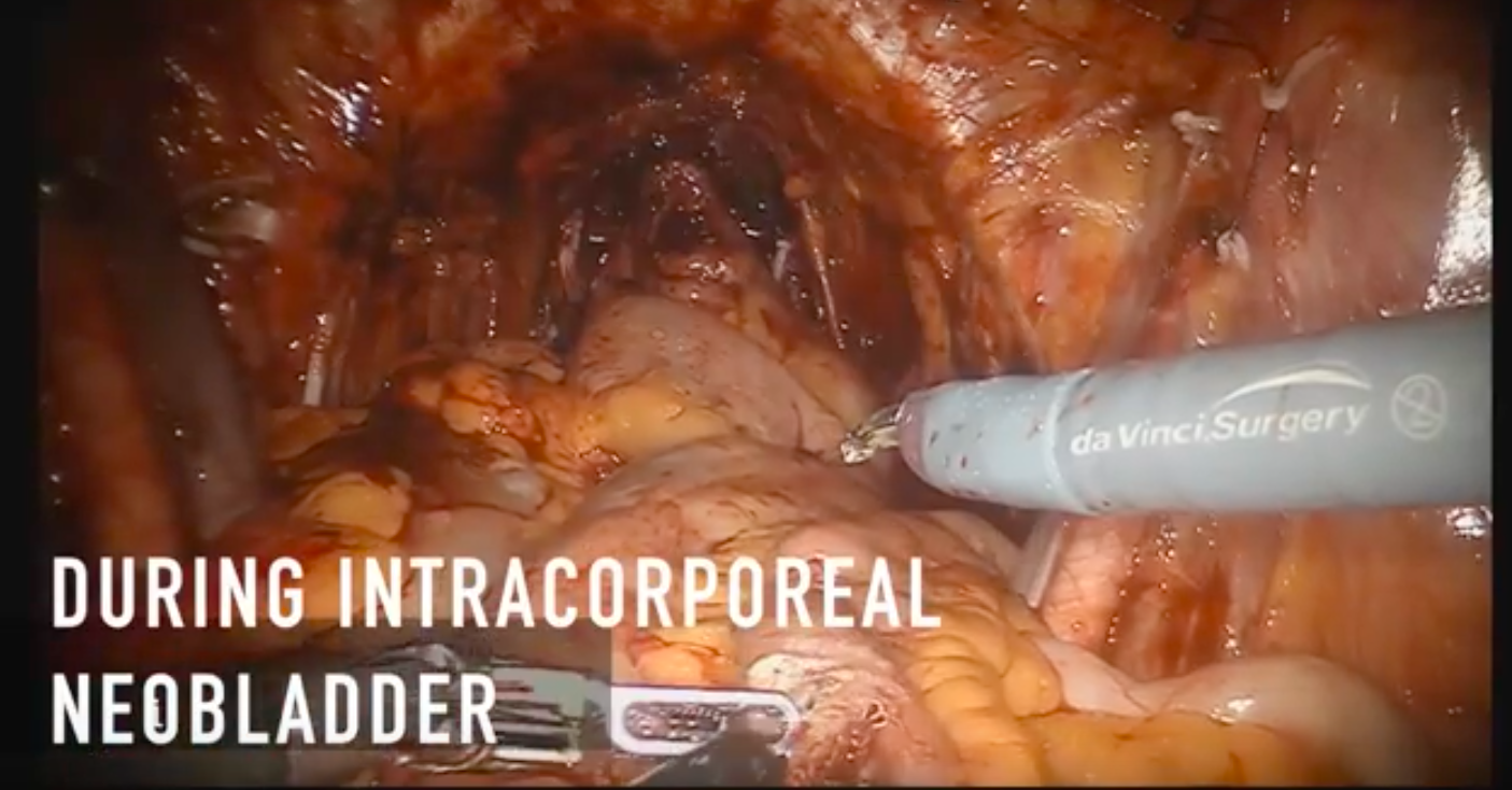 Elefant during intracorporeal neobladder