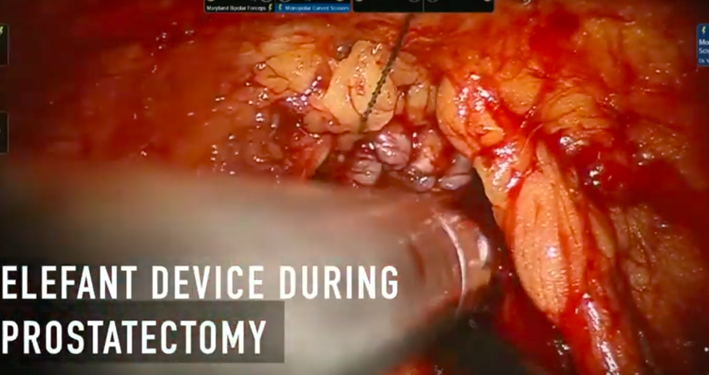 Elefant device during prostatectomy