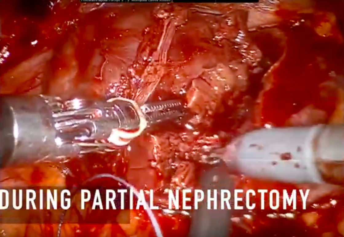 Partial nephrectomy Elefant by Coloplast laparoscopic devices