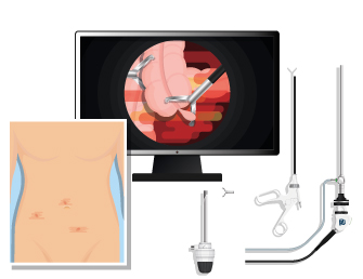 Elefant-laparoscopy-operation